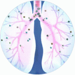 Asthma atacks