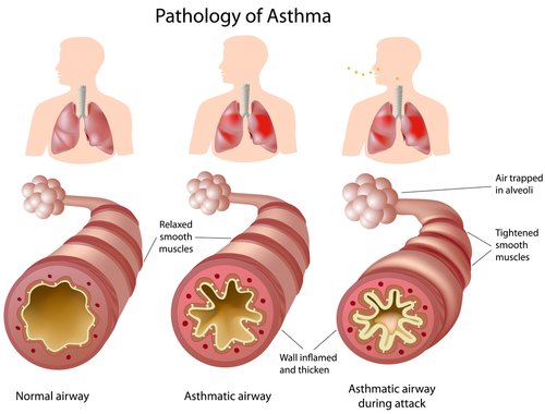 Asthma atacks