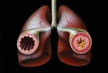 bronchial asthma