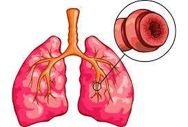 bronchial hyperreactivity