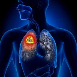 Bronchial asthma