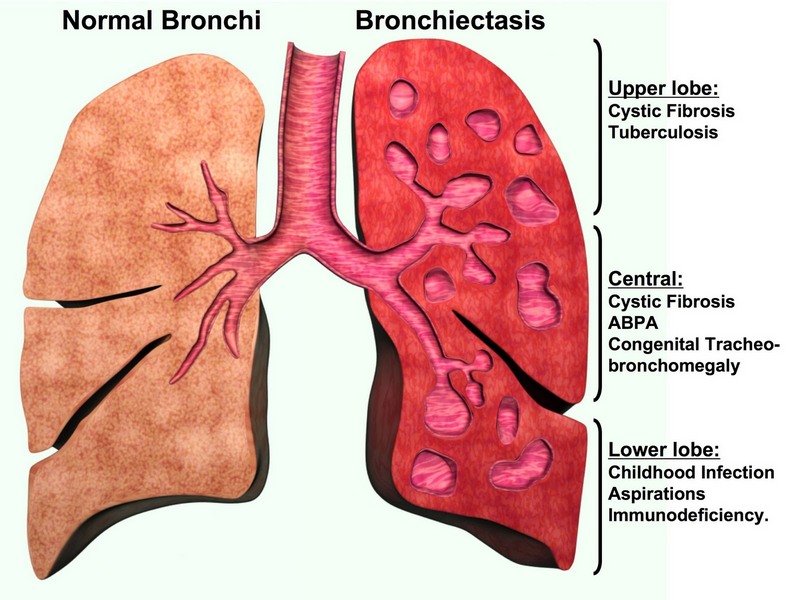 chronic bronchitis lung sounds