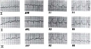 Figure 1. The initial ECG taken one hour after the ingestion of aspirin during the acute asthmatic attack, showing the ST segment elevation in V,-V4.