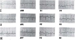 Figure 2. The followup ECG taken 20 minutes following the treatment with intravenous nitroglycerin and oral nifedipine, showing the resolution of the ST segment elevation.