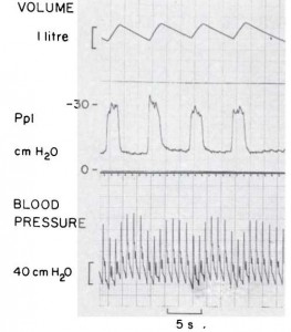 Figure 1. Pulsus paradoxus induced by expiratory resistance in normal subject. A five second time interval is indicated.