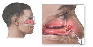 Nasal biopsies