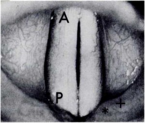 normal endolarynx