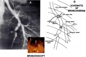 Bronchial Tree