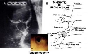 Bronchial Tree