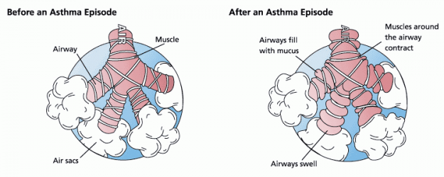 asthma